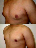 27 Year Old Male With Gynecomastia (enlarged Breasts) By Dr. Franklin D. Richards, MD, Bethesda Plastic Surgeon