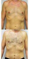 27 Year Old Man Treated With Male Breast Reduction Before After By Doctor Jonathan Hall, MD, Boston Plastic Surgeon