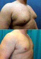 27 Year Old Man Treated With Male Breast Reduction By Doctor David Janssen, MD, FACS, Oshkosh Plastic Surgeon