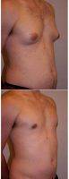 27 Year Old Man Treated With Male Breast Reduction By Doctor John Williams, MD, Scottsdale Plastic Surgeon