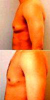27 Year Old Man Treated With Male Breast Reduction By Doctor Keshav Magge, MD, Bethesda Plastic Surgeon