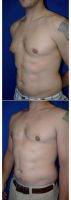 27 Year Old Man Treated With Male Breast Reduction By Dr Carlos Mata, MD, MBA, FACS, Scottsdale Plastic Surgeon
