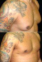 27 Year Old Man Treated With Male Breast Reduction By Dr Emmanuel Mallol Cotes, MD, Dominican Republic Plastic Surgeon