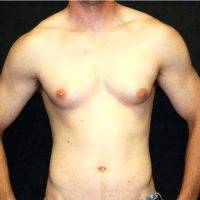 27 Year Old Man Treated With Male Breast Reduction By Dr Jeffrey D. Wagner, MD, Indianapolis Plastic Surgeon
