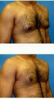 27 Year Old Man Treated With Male Breast Reduction By Dr. Jason E. Leedy, MD, Cleveland Plastic Surgeon