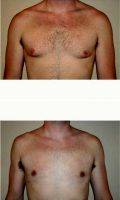 27 Year Old Man Treated With Male Breast Reduction With Doctor Tim Neavin, MD, Beverly Hills Plastic Surgeon