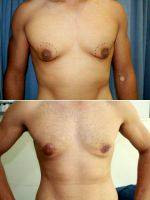 27 Years British Male Gym Trainer Suffering From Male Breast Enlargement With Ptosis For Past 2 Years By Dr. Ashok Govila, FRCS, MCh, MS, Dubai Plastic Surgeon