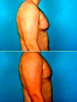 27yo Male Excision Of Gynecomastia By Doctor Steven J. Smith, MD, Knoxville Plastic Surgeon
