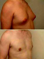 28 Year Old Male With Enlarged Breast Gynecomastia By Doctor Franklin D. Richards, MD, Bethesda Plastic Surgeon