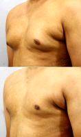 28 Year Old Man Treated With Asymmetric Gynecomastia By Dr Milan Doshi, MS, MCh, India Plastic Surgeon