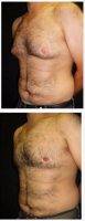 28 Year Old Man Treated With Male Breast Reduction By Doctor George Bitar, MD, Fairfax Plastic Surgeon
