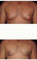 28 Year Old Man Treated With Male Breast Reduction By Doctor Jeffrey Umansky, MD, La Jolla Plastic Surgeon