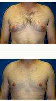 28 Year Old Man Treated With Male Breast Reduction By Dr Babak Dadvand, MD, Los Angeles Plastic Surgeon