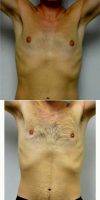 28 Year Old Man Treated With Male Breast Reduction By Dr Jonathan Hall, MD, Boston Plastic Surgeon