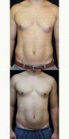 28 Year Old Man Treated With Male Breast Reduction By Dr. Kris M. Reddy, MD, FACS, West Palm Beach Plastic Surgeon
