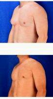 28 Year Old Man Treated With Male Breast Reduction By Dr. Mark T. Boschert, MD, Saint Louis Plastic Surgeon