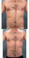 28 Year Old Man Treated With Male Breast Reduction By Dr. Marvin F. Shienbaum, MD, Brandon Plastic Surgeon
