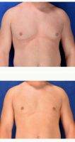 28 Year Old Man Treated With Male Breast Reduction For Gynecomastia Before By Dr Mark T. Boschert, MD, Saint Louis Plastic Surgeon