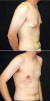 28 Year Old Man Treated With Male Breast Reduction With Dr Jeffrey D. Wagner, MD, Indianapolis Plastic Surgeon