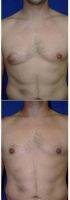 28 Year Old Man Treated With Male Breast Reduction With Dr. Carlos Mata, MD, MBA, FACS, Scottsdale Plastic Surgeon
