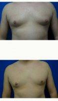 28 Year Old Man Treated With Male Breast Reduction With Dr. James Shoukas, MD, Lake Mary Plastic Surgeon