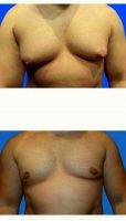 29 Year Old Male, Gynecomastia With Dr. Stephen T. Greenberg, MD, Woodbury Plastic Surgeon
