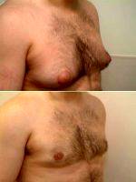 29 Year Old Male Who Complains Of Enlarged Breasts (gynecomastia) By Dr Franklin D. Richards, MD, Bethesda Plastic Surgeon