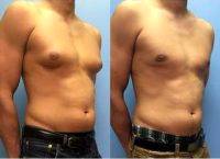 29 Year Old Man Treated With Male Breast Reduction Before After By Dr Jason M. Petrungaro, MD, FACS, Munster Plastic Surgeon
