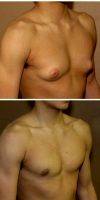 29 Year Old Man Treated With Male Breast Reduction By Doctor Gregory Turowski, MD, PhD, FACS, Chicago Plastic Surgeon
