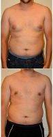 29 Year Old Man Treated With Male Breast Reduction By Doctor M. Mark Mofid, MD, La Jolla Plastic Surgeon