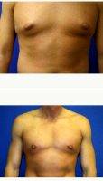 29 Year Old Man Treated With Male Breast Reduction By Dr Laura Randolph, MD, Bloomington Plastic Surgeon