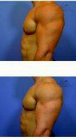 29 Year Old Man Treated With Male Breast Reduction By Dr. Carlos O. Chacon, MD, MBA, Chula Vista Physician