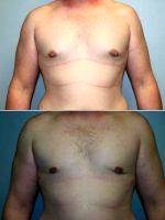 30 Year Old Male With Doctor Leo Lapuerta, MD, Houston Plastic Surgeon