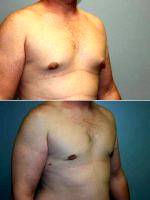 30 Year Old Male With Doctor Leo Lapuerta, MD, Houston Plastic Surgeon