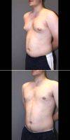 30 Year Old Man Treated For Male Breast Reduction With Doctor Lee B. Daniel, MD, Eugene Plastic Surgeon