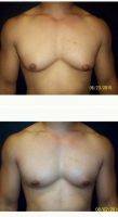 30 Year Old Man Treated With Lipo And Open Excision Gynecomastia By Doctor Kevin Dieffenbach, MD, Oahu Island Plastic Surgeon