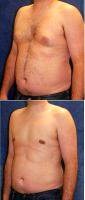 30 Year Old Man Treated With Male Breast Reduction By Doctor James A. Hoffman