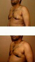 30 Year Old Man Treated With Male Breast Reduction By Dr Gregory Turowski, MD, PhD, FACS, Chicago Plastic Surgeon