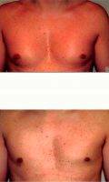 30 Year Old Man Treated With Male Breast Reduction By Dr. Franklin D. Richards, MD, Bethesda Plastic Surgeon