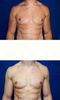 30 Year Old Man Treated With Male Breast Reduction With Doctor Zoran Potparic, MD, Fort Lauderdale Plastic Surgeon