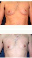 30 Year Old Man Treated With Male Breast Reduction With Dr Bernard Kopchinski, MD, FACS, San Antonio Plastic Surgeon