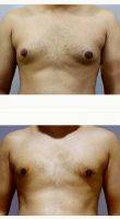 30 Year Old Man Treated With Male Breast Reduction With Dr Milan Doshi, MS, MCh, India Plastic Surgeon