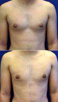 30 Year Old Man Treated With Male Breast Reduction With Dr. Saul Lahijani, MD, Los Angeles Physician
