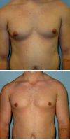 30 Year Old Man Treated With Male Breast Reduction With Dr. Sean T. Lille, MD, Scottsdale Plastic Surgeon