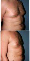 31 Year Old Male Breast Reduction By Dr. Marvin F. Shienbaum, MD, Brandon Plastic Surgeon