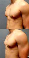 31 Year Old Man Treated With Male Breast Reduction By Doctor Kahlil Andrews, MD, Cedar Rapids Plastic Surgeon