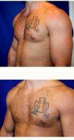 31 Year Old Man Treated With Male Breast Reduction By Doctor Robert Peterson, MD, Honolulu Plastic Surgeon