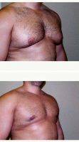 31 Year Old Man Treated With Male Breast Reduction By Dr Kenneth Dickie, MD, FRCSC, Barrie Plastic Surgeon