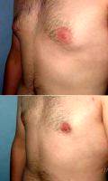 31 Year Old Man Treated With Male Breast Reduction By Dr. Sean T. Lille, MD, Scottsdale Plastic Surgeon