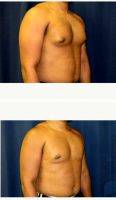 31 Year Old Man Treated With Male Breast Reduction With Dr. Theodore Nyame, MD, Charlotte Physician